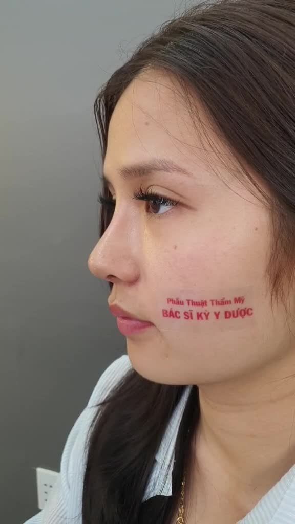 KẾT QUẢ NÂNG MŨI ALINE SAU 9 NGÀY