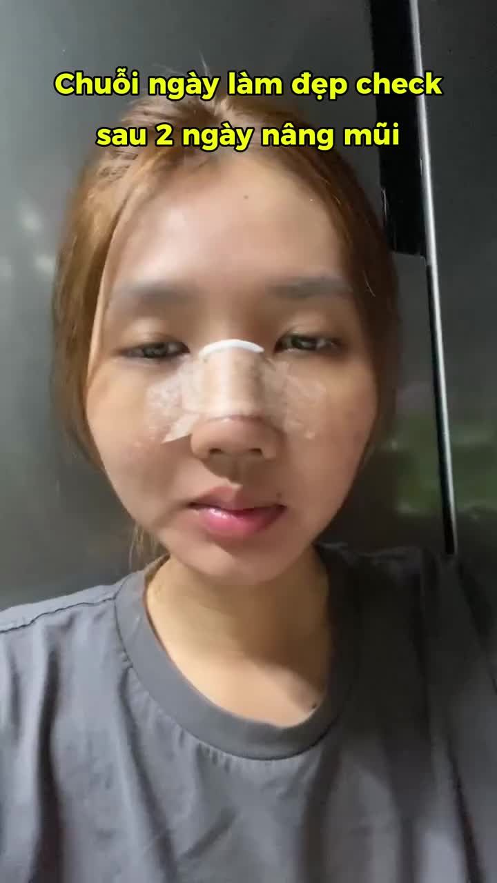BỊ "SƯNG" sau 2 ngày nâng mũi là hiện tượng gì?