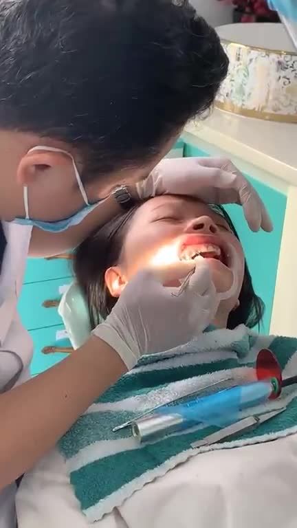 Sau khi trồng răng implant bác sĩ Dương Răng SmileOne tiến hành gắn mắc cài 3M