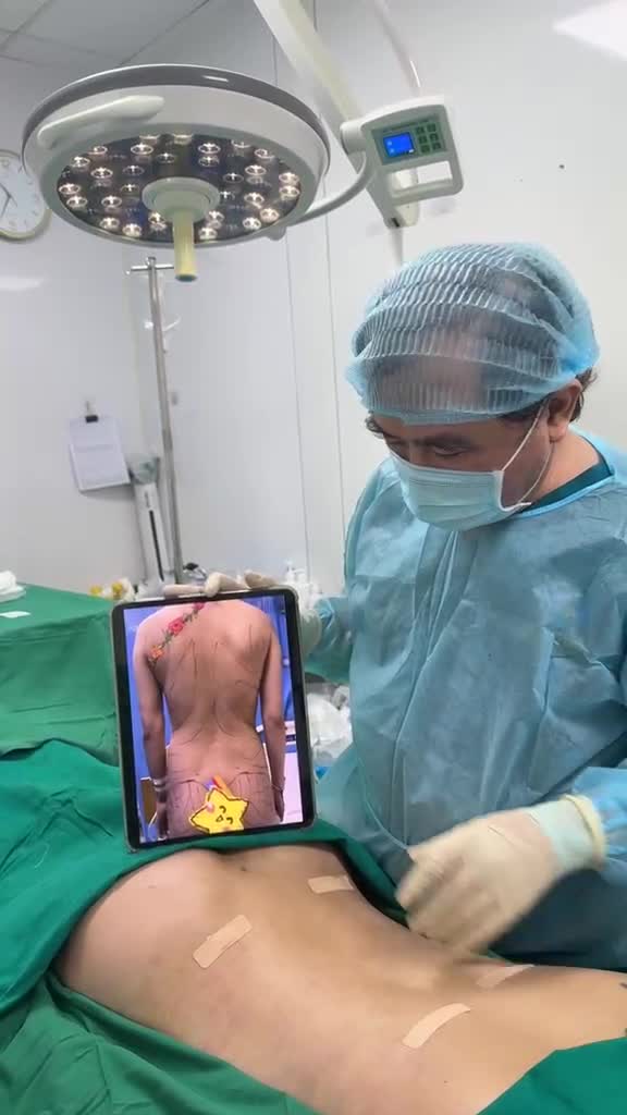 Hút mỡ bụng 360 độ (bụng, hông, eo), hút mỡ lưng nách và cấy mỡ mông cho bạn gái Quảng Ninh