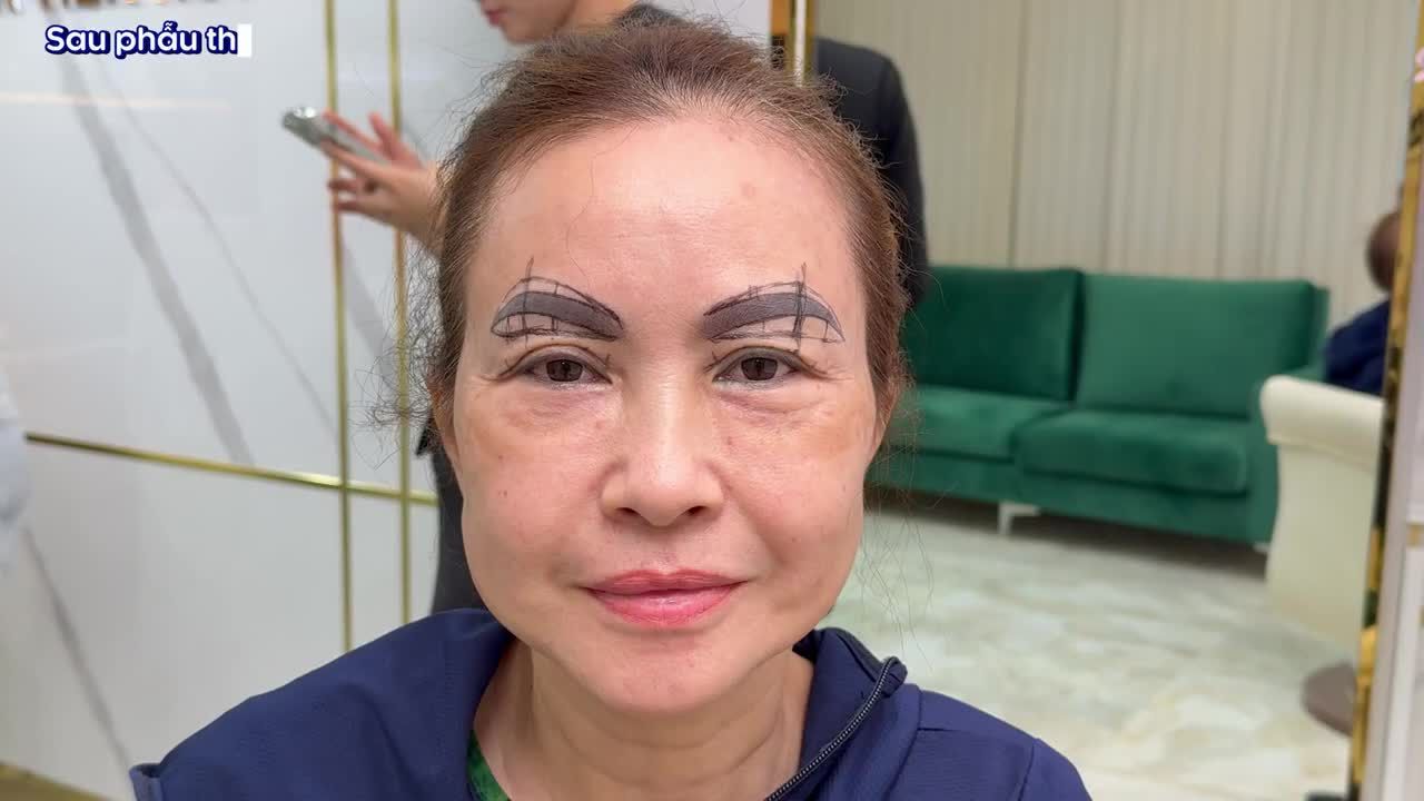 ĐẢO NGƯỢC TIẾN TRÌNH LÃO HÓA TRONG TÍCH TẮC VỚI KĨ THUẬT DEEP PLANE FACELIFT