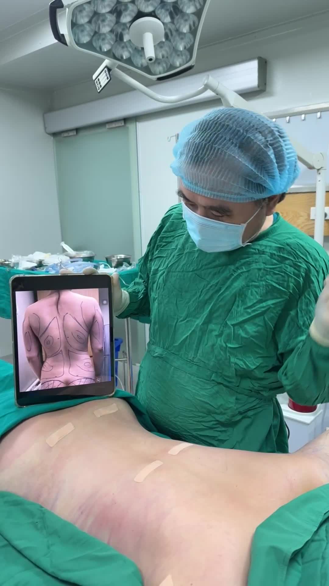 Siêu combo hút mỡ bụng 360 độ, lưng, tay, nách, cằm, cấy mỡ mông và tạo hình bụng cho bạn gái Kiên Giang