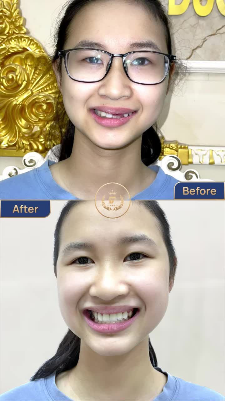 TRỒNG RĂNG IMPLANT – GIẢI PHÁP TOÀN DIỆN CHO MỌI TÌNH TRẠNG MẤT RĂNG