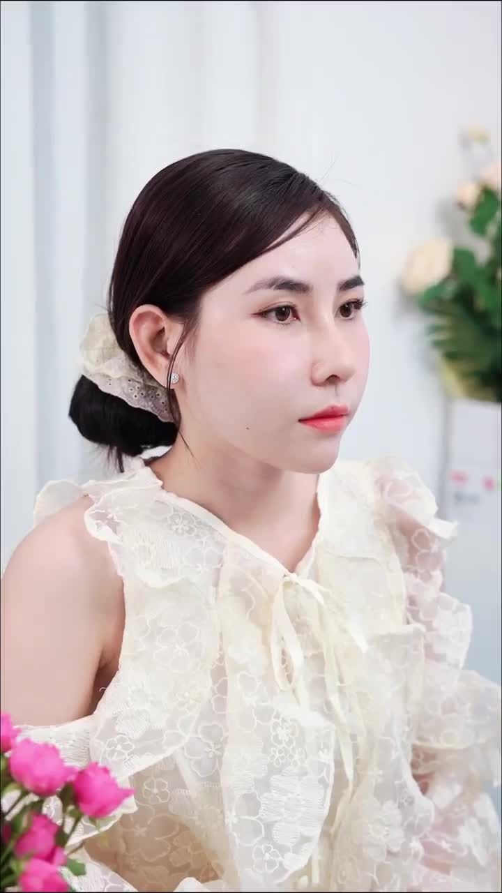 SAU 9 NGÀY XỬ LÝ CHỈ - TÁI CẤU TRÚC MŨI  KH. NGUYỄN T.HUYỀN