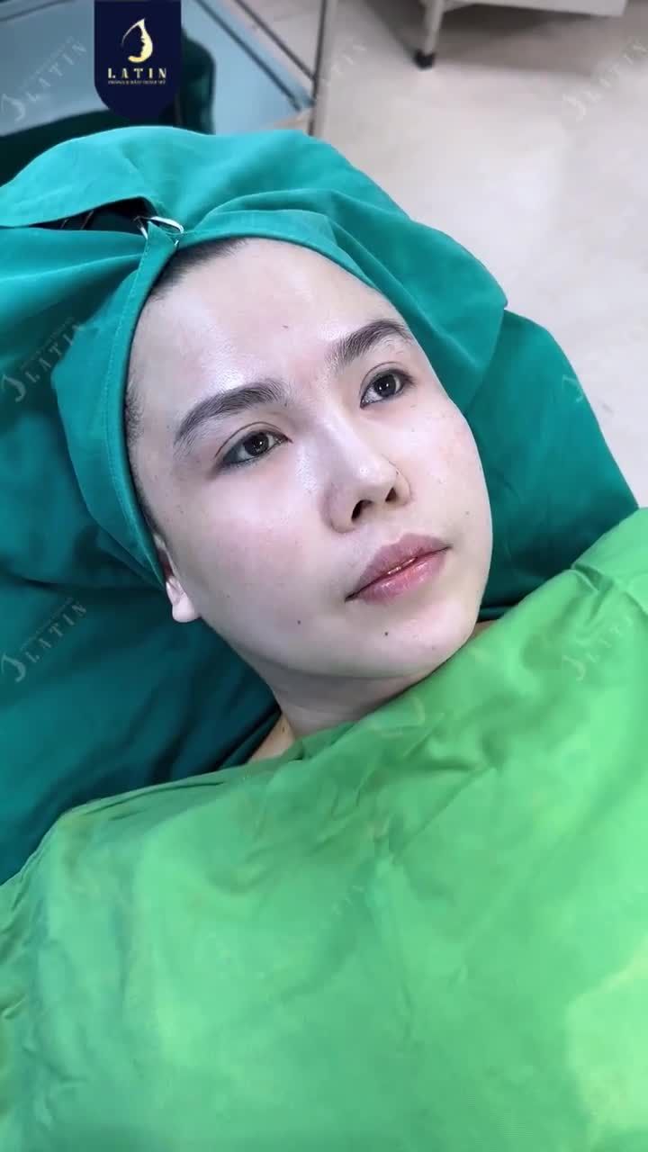 CA ĐỘN THÁI DƯƠNG VÀ CẤY M.Ỡ TRẺ HÓA GƯƠNG MẶT