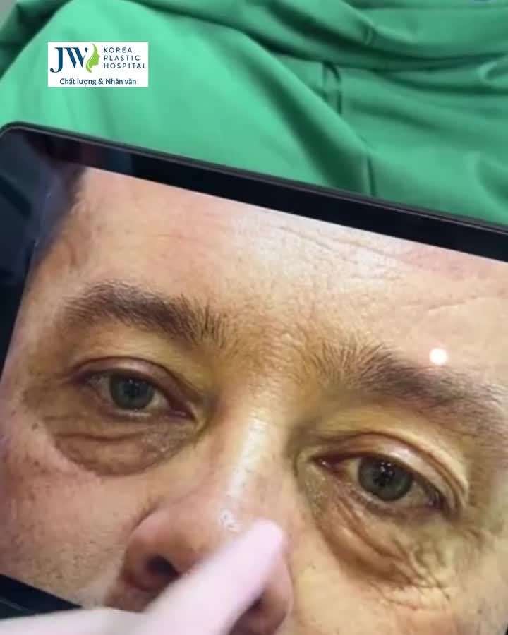 GIẢI CỨU ĐÔI MẮT LÃO HÓA QUÝ ÔNG NGƯỜI MỸ U50 TRẺ RA 10 TUỔI NHỜ MIDFACE 3 IN 1 TẠI JW