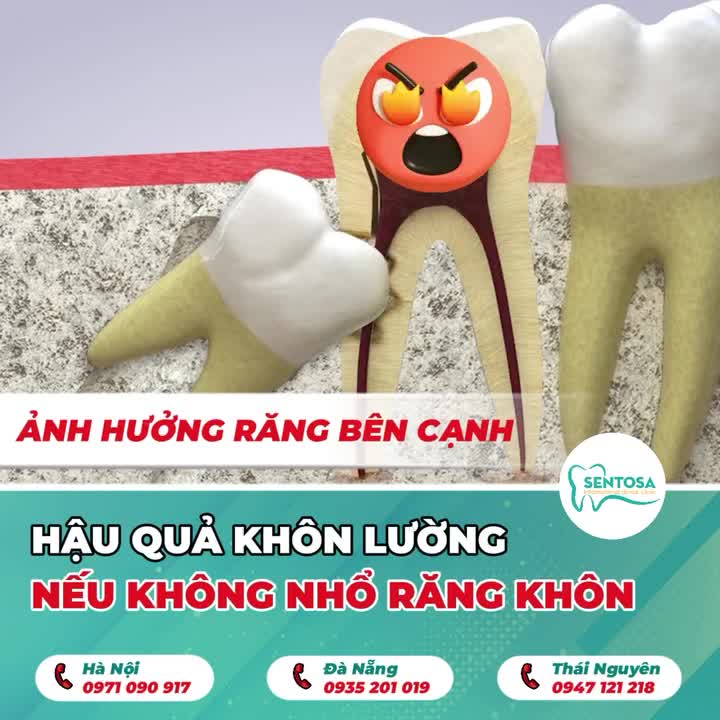 CHỈ TỪ 799K ĐỂ “CẮT ĐỨT” NỖI ĐAU ÂM Ỉ MANG TÊN RĂNG KHÔN