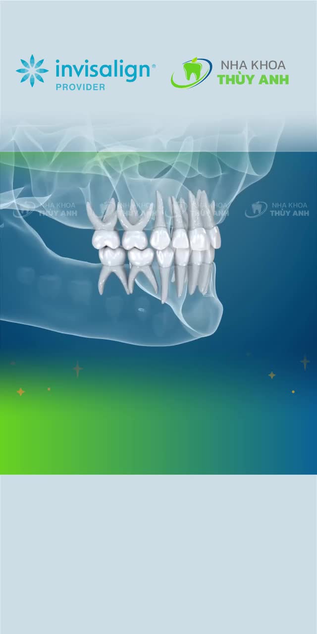 MÙA HẠ VÀO INVISALIGN