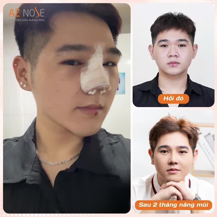 Nam sinh nâng mũi - tại sao không