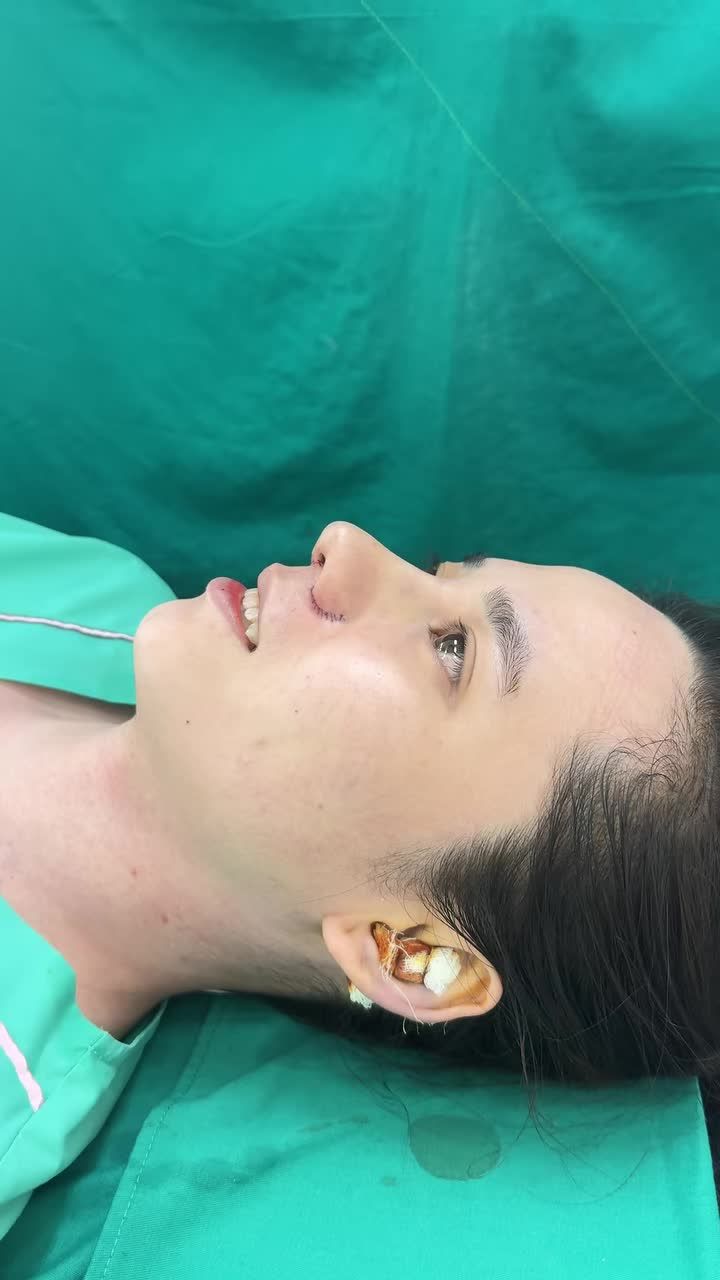 Case mũi cấu trúc cuộn cánh vừa hoàn thành!