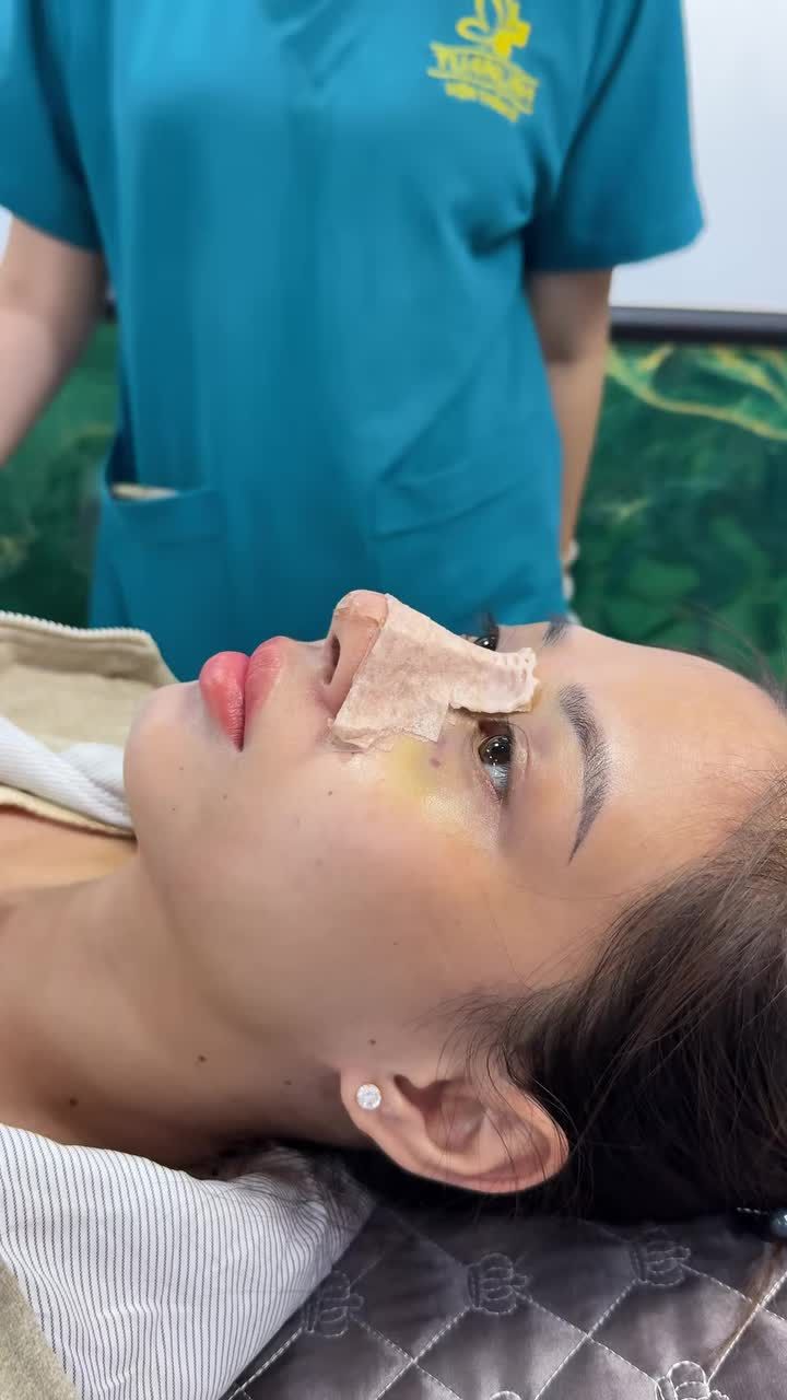Combo nâng mũi + nâng v1 được 10 ngày .