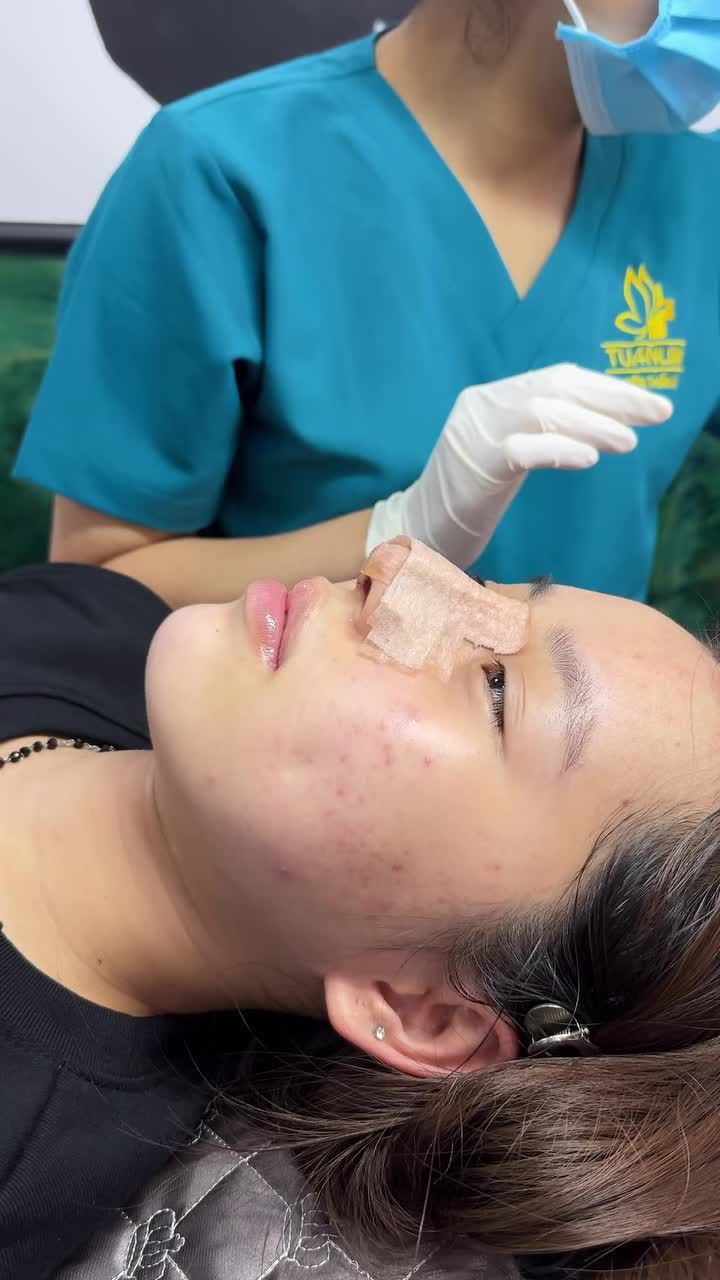 Case mũi cấu trúc được 5 ngày