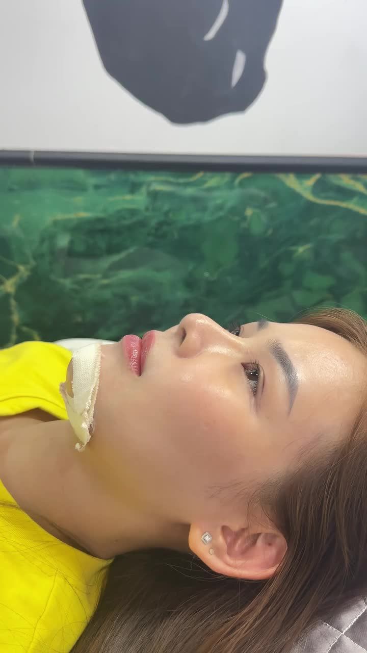 Case cằm được 7 ngày