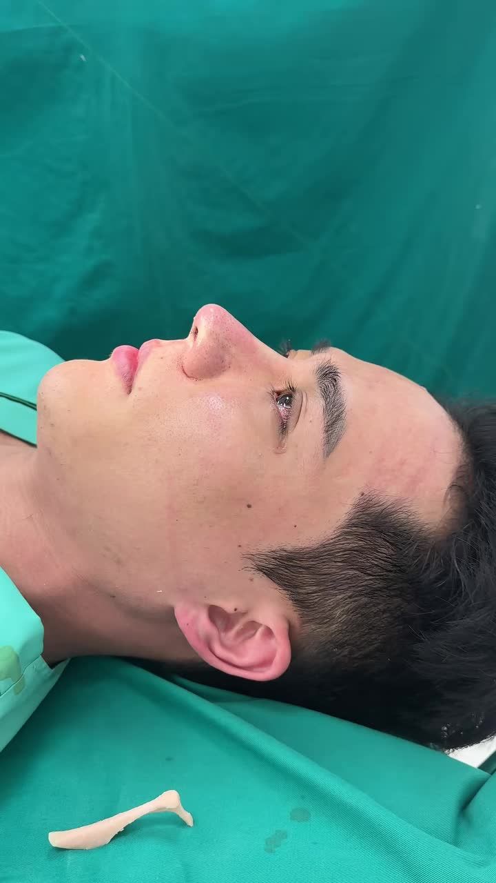 Case mũi cấu trúc sửa lại cho khách hàng nam vừa hoàn thành!!