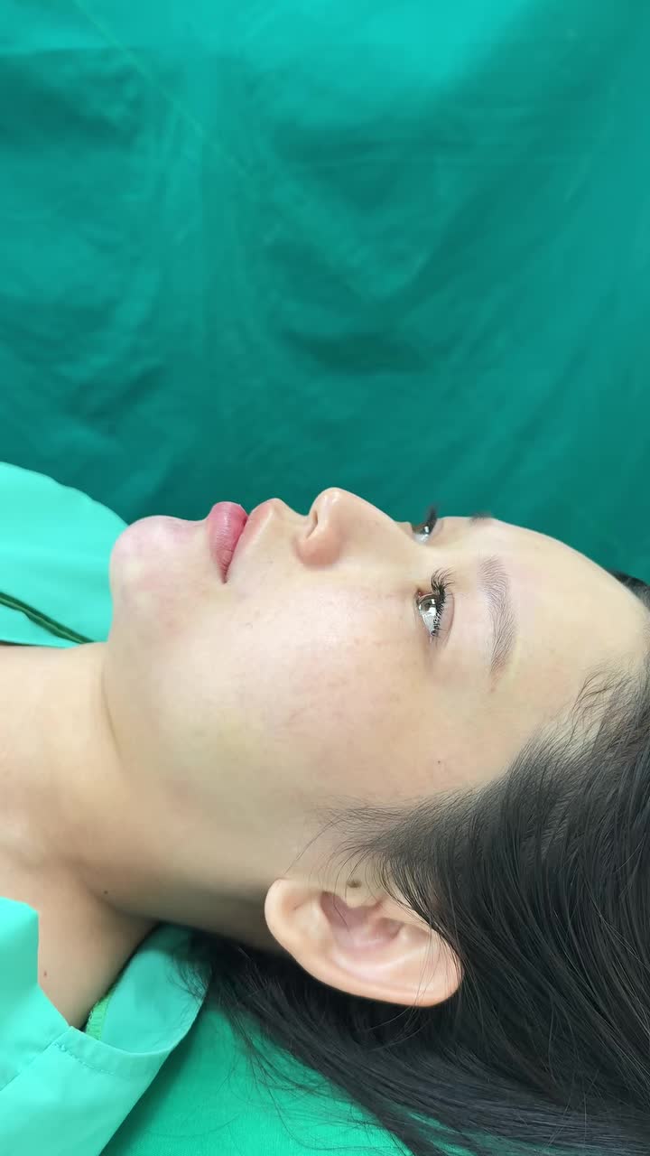 Case độn cằm vừa mới hoàn thành!!