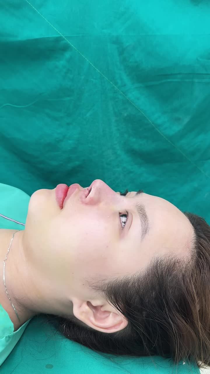 Case mũi bọc sụn rút chỉ vừa hoàn thành!!