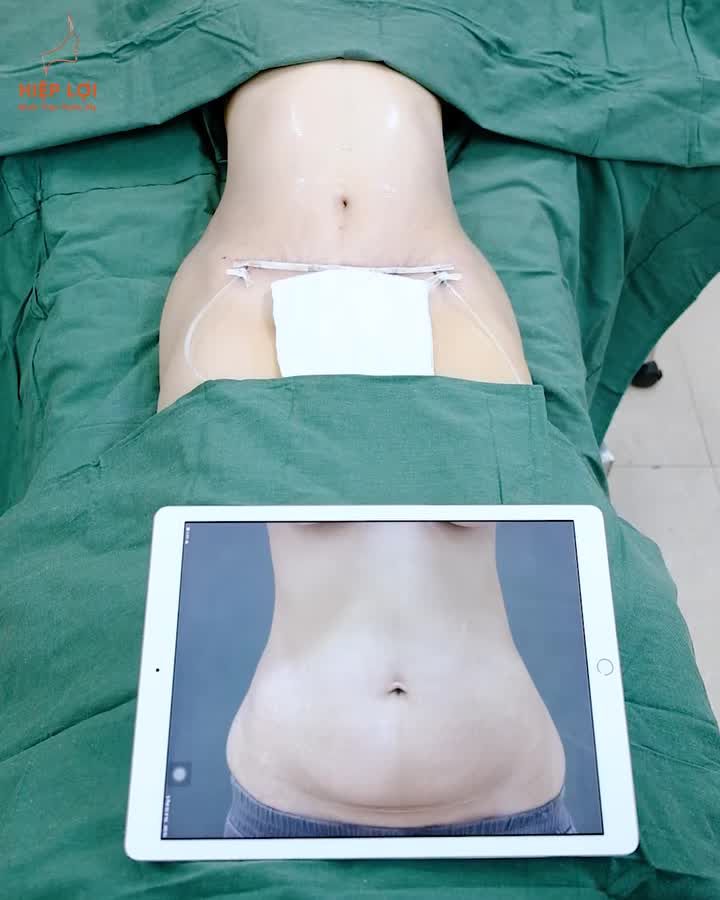 CA HÚT MỠ, CĂNG DA BỤNG TẠI PHÒNG MỔ – HIỆP LỢI]