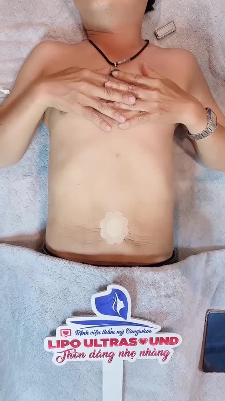 1 THÁNG SAU GIẢM MỠ LIPO ULTRASOUND – ANH T. TÁI KHÁM VỚI VÒNG BỤNG SĂN CHẮC, TẠM BIỆT “BỤNG BIA”!
