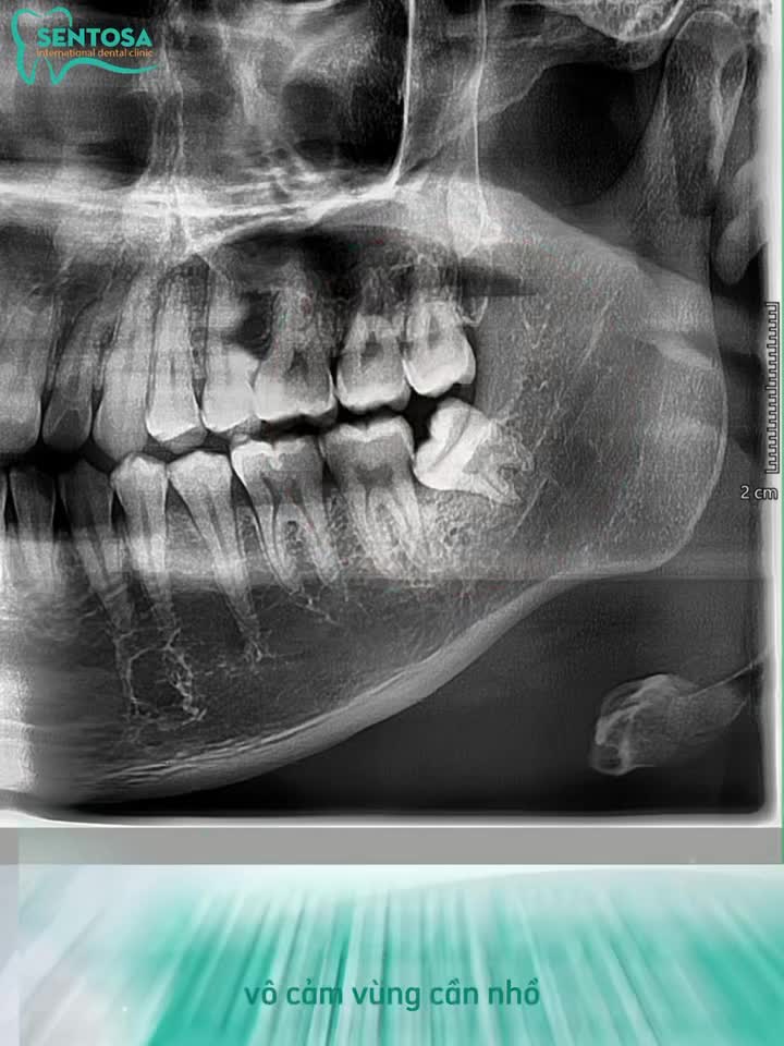 NHỔ RĂNG KHÔN CÓ THẬT SỰ ĐAU NHƯ BẠN NGHĨ ?