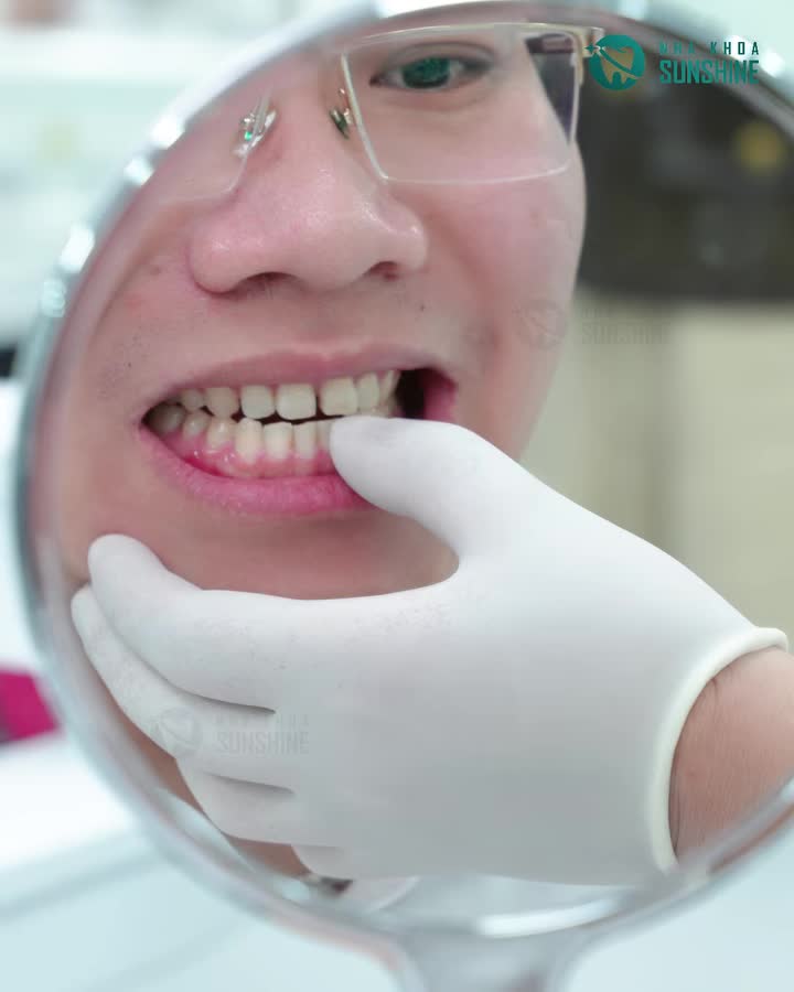 Thưa răng cửa chọn phương pháp dán sứ veneer để bảo tồn răng gốc tối đa