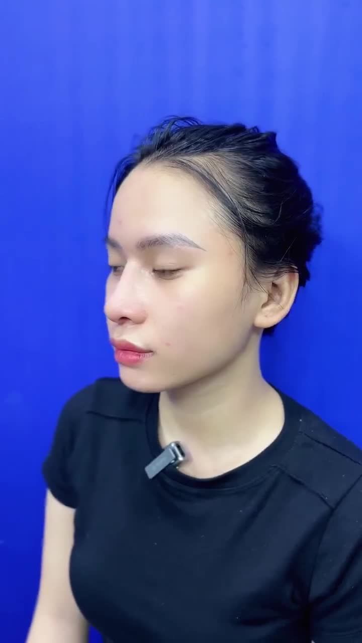 BẠN H.L. LỘT XÁC VỚI NÂNG MŨI CẤU TRÚC 3D TẠI STARBEAUTY – DÁNG MŨI HOÀN HẢO, NHAN SẮC ĐỈNH CAO!