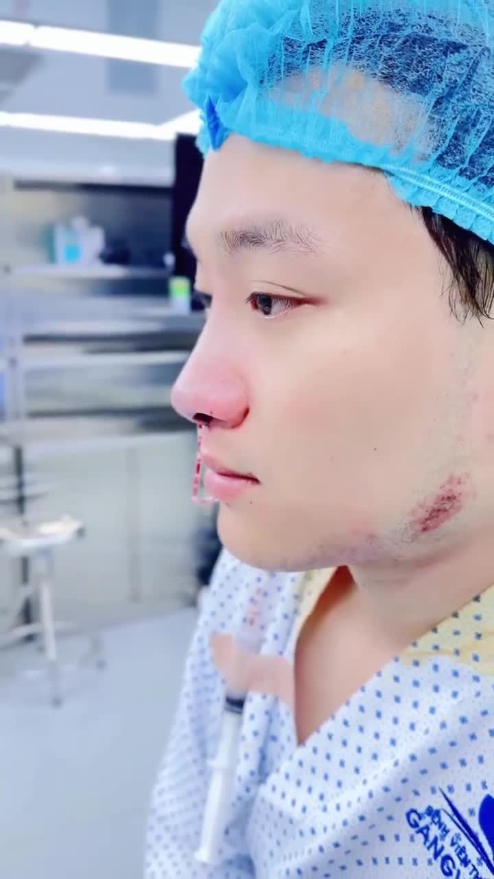 ANH H.V. LỘT XÁC VỚI NÂNG MŨI CẤU TRÚC 3D TẠI GANGWHOO – DÁNG MŨI NAM TÍNH, DIỆN MẠO ĐỈNH CAO!