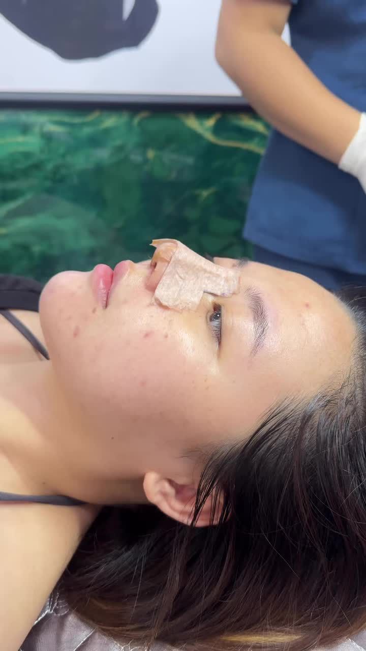 Case mũi cấu trúc surgiform được 5 ngày - Mũi hết sưng bầm, đang vào form dáng chuẩn.