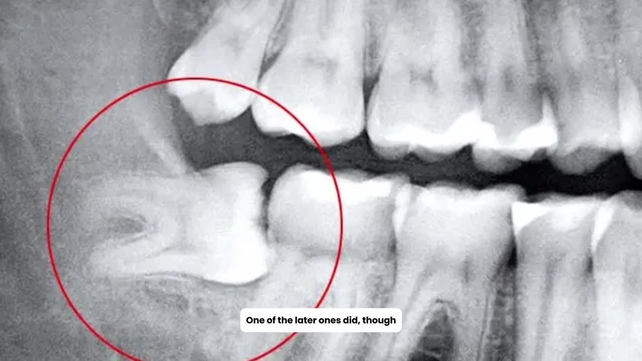 NHỔ RĂNG KHÔN NHANH HƠN MÌNH NGHĨ!