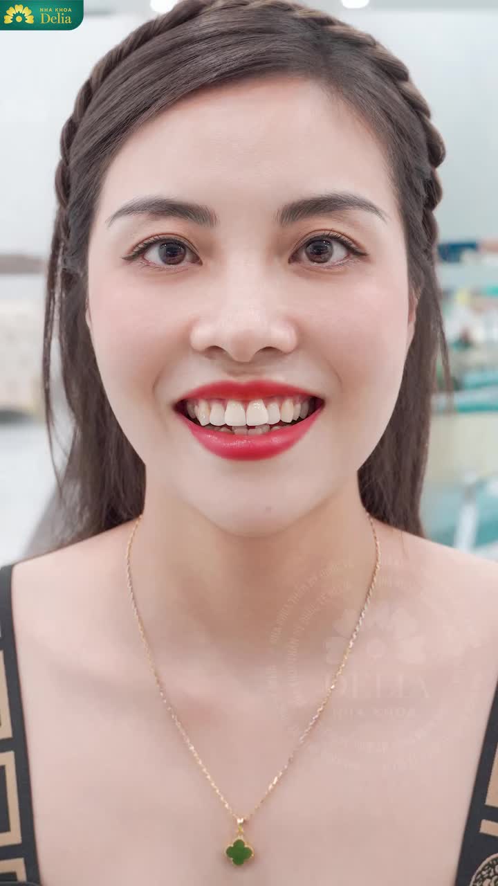 Chị đã quyết định thay đổi nụ cười của mình tại nha khoa Delia. Không phải vì chạy theo cái đẹp, mà vì muốn tự tin hơn khi xuất hiện trước khách hàng.
