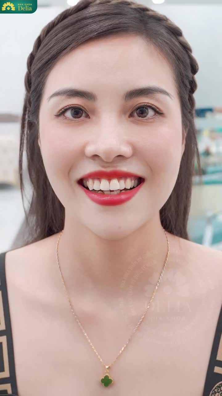 Chị đã quyết định thay đổi nụ cười của mình tại nha khoa Delia. Không phải vì chạy theo cái đẹp, mà vì muốn tự tin hơn khi xuất hiện trước khách hàng.