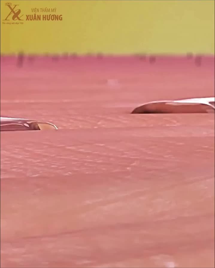 Giải pháp xử lý mùi cơ thể hiệu quả mùa hè – Hút nội soi tuyến mồ hôi nách tại Xuân Hương