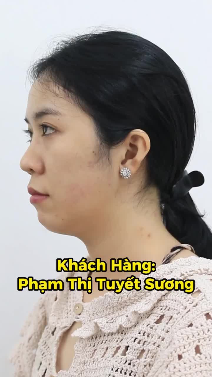 Chỉ sau 1h30p, nàng khách đã có màn nâng cấp mũi mới do Bác sĩ Long trực tiếp thực hiện, chỉnh dáng tỉ mỉ – kết quả khiến ai cũng phải trầm trồ!