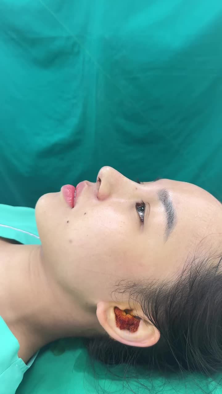 Case mũi nâng cấp cấu trúc vừa hoàn thành cho bạn gái đến từ Đà Nẵng - Dáng mũi cao tây sắc nét.