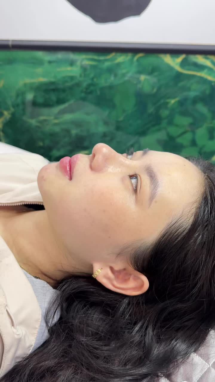 Tái khám mũi sau 2 tháng - Dáng mũi vào form chuẩn đẹp tự nhiên.