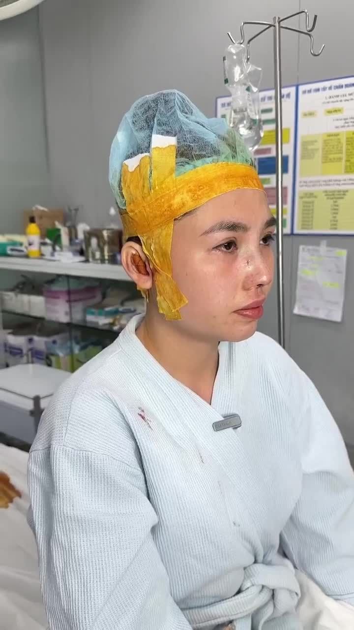 KẾT QUẢ SAU 60 PHÚT NÂNG MŨI CẤU TRÚC - THỰC HIỆN BỞI EKIP BÁC SĨ HOẠT
