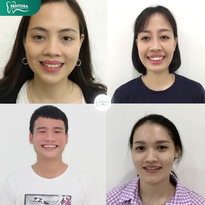GẠT BỎ RĂNG HÔ - THƯA - MÓM - KHẤP KHỂNH CHỈ SAU 120 GIÂY