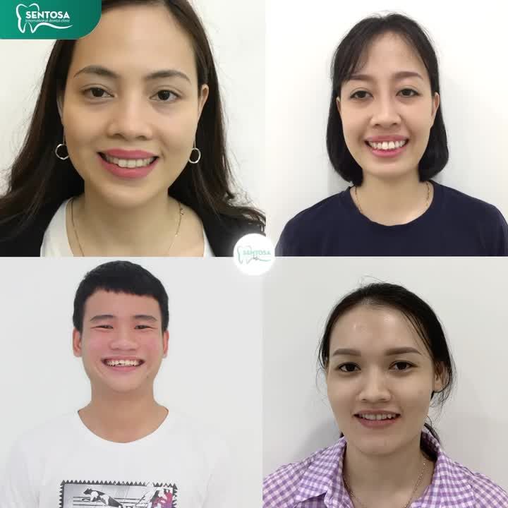 GẠT BỎ RĂNG HÔ - THƯA - MÓM - KHẤP KHỂNH CHỈ SAU 120 GIÂY