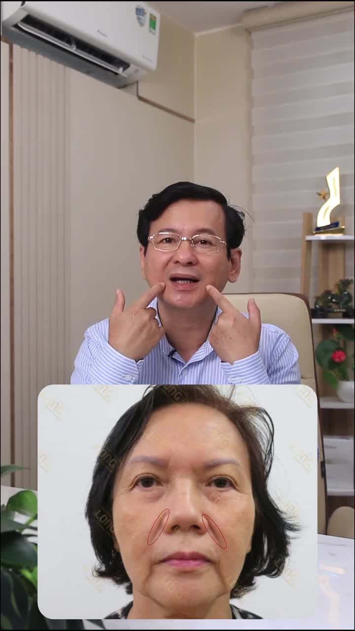Bác sĩ Long chia sẻ phương pháp xóa rãnh râu rồng (rãnh cười) hiệu quả sau 30 phút?