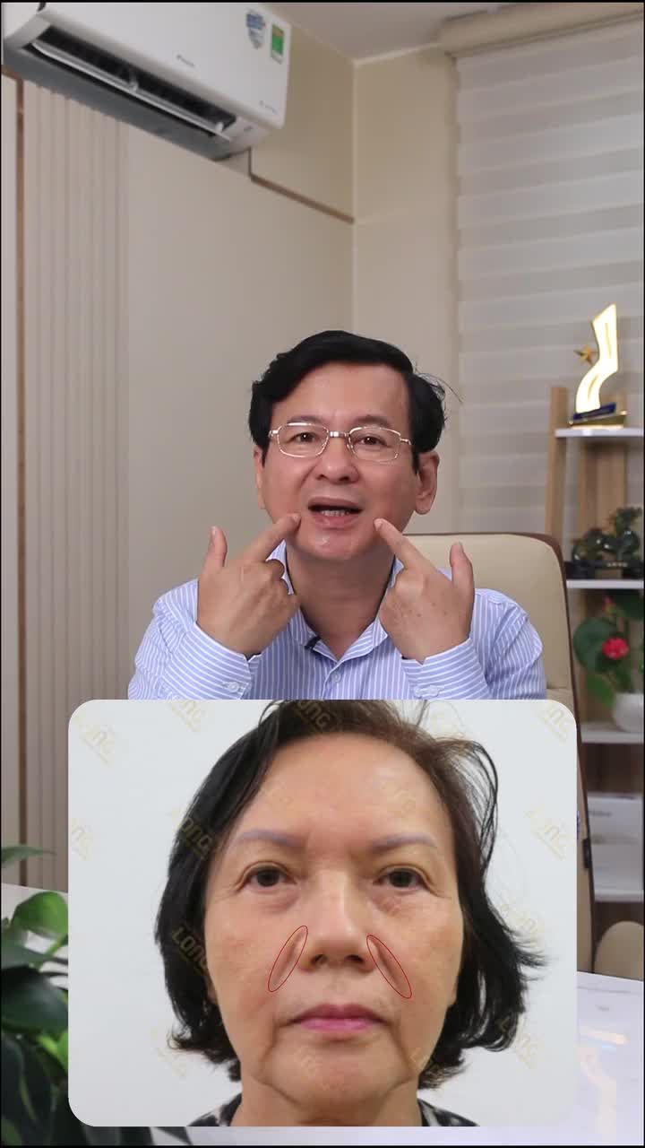 Bác sĩ Long chia sẻ phương pháp xóa rãnh râu rồng (rãnh cười) hiệu quả sau 30 phút?