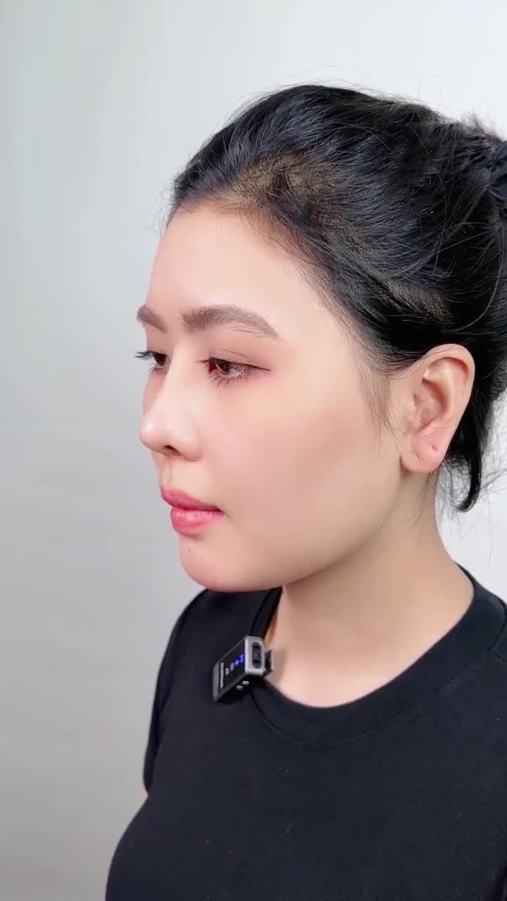 BẠN NỮ TRẺ TUỔI LỘT XÁC NHAN SẮC SAU 15 NGÀY NÂNG MŨI TẠI GANGWHOO – DÁNG MŨI THANH THOÁT, GƯƠNG MẶT NỔI BẬT!