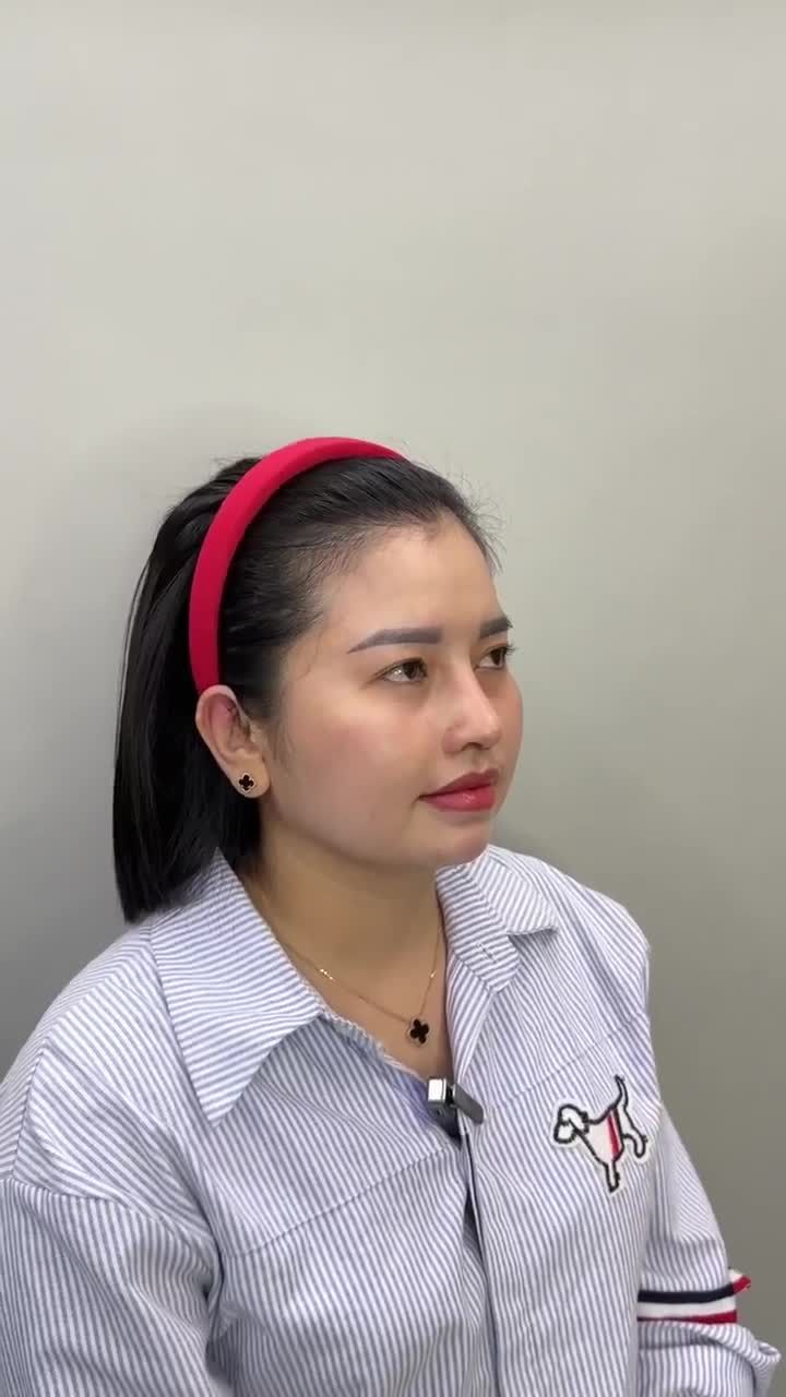 CHỊ KHÁCH HÀNG SAU 14 NGÀY NÂNG MŨI CẤU TRÚC | KH. DIỄM TRANG (CẦN THƠ)
