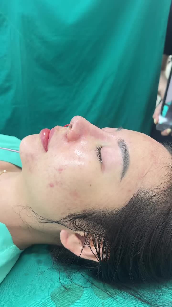 Case mũi cấu trúc vừa hoàn thành - Dáng mũi tự nhiên, sắc nét sau 90 phút!!