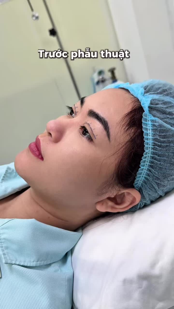 PHẪU THUẬT NÂNG MŨI + NHẤN MÍ TẠI KAT