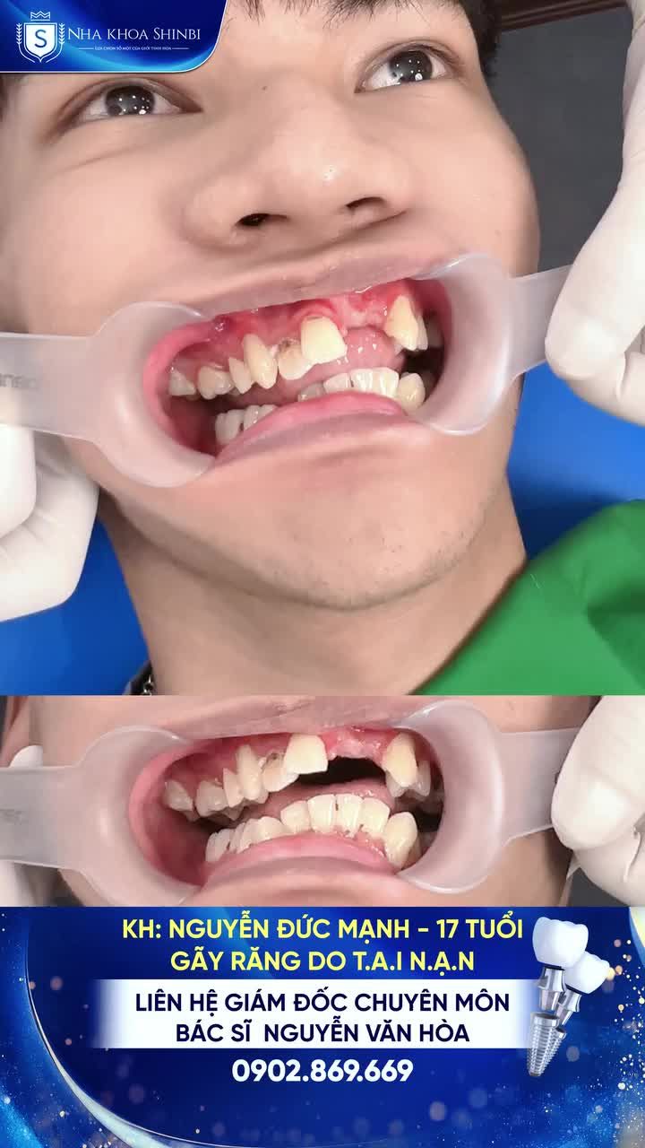 Phục hình càng sớm càng tốt, để tránh tiêu xương và ảnh hưởng thẩm mỹ về sau.