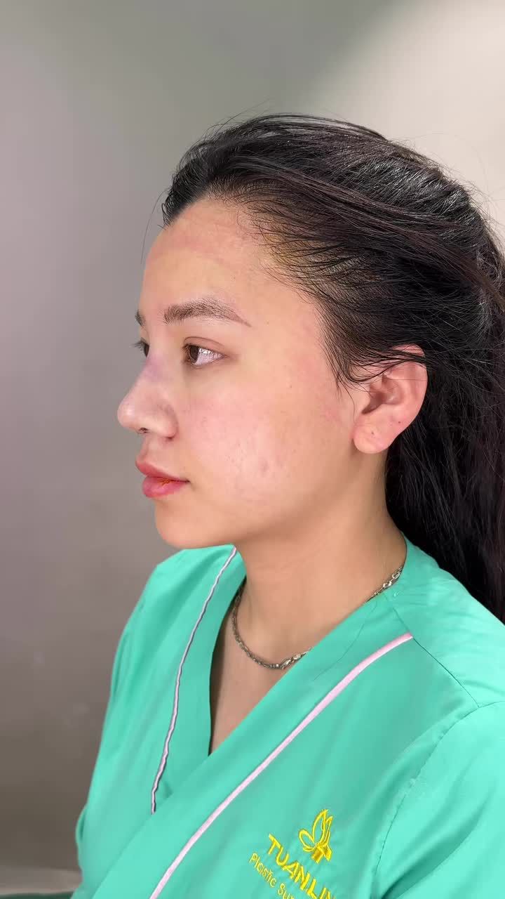 Case mũi cấu trúc surgiform vừa hoàn thành - Dáng mũi đẹp xuất sắc!!