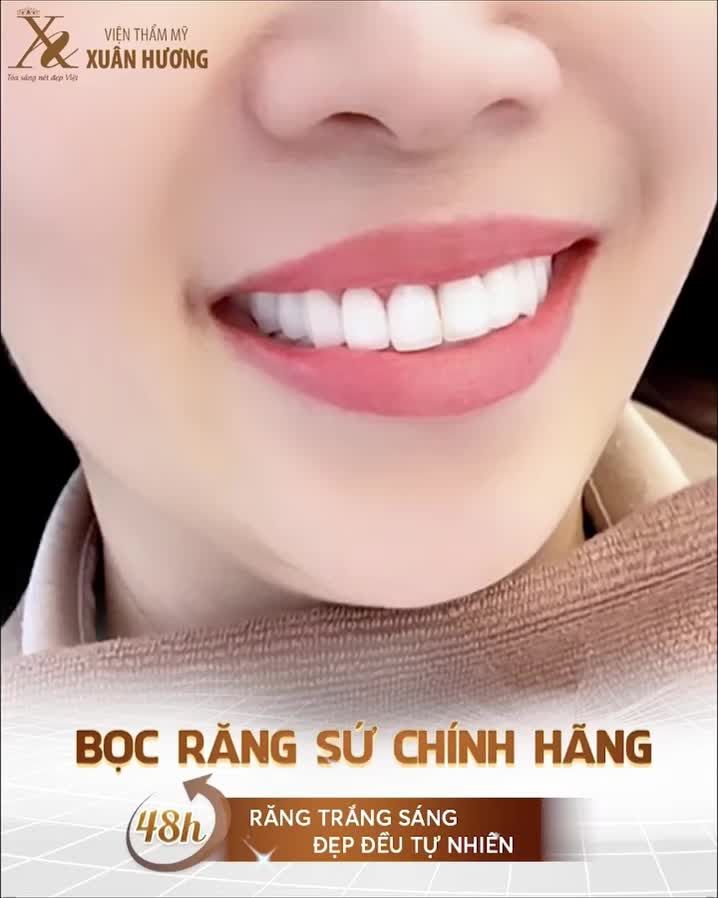CÔNG NGHỆ BỌC RĂNG SỨ CHÍNH HÃNG – HOÀN THIỆN CHỈ SAU 48 GIỜ