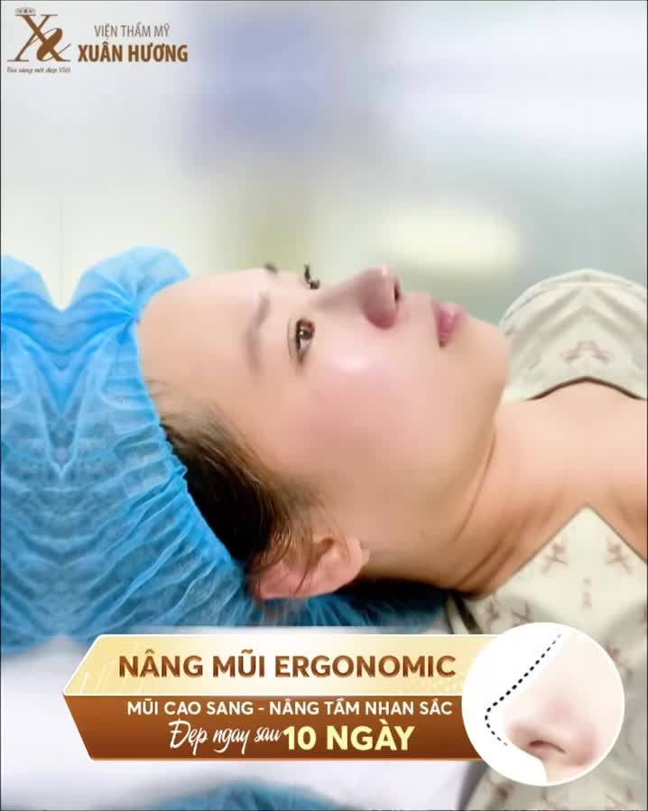 Ngày thứ 10 sau khi Nâng mũi tại VTM Xuân Hương