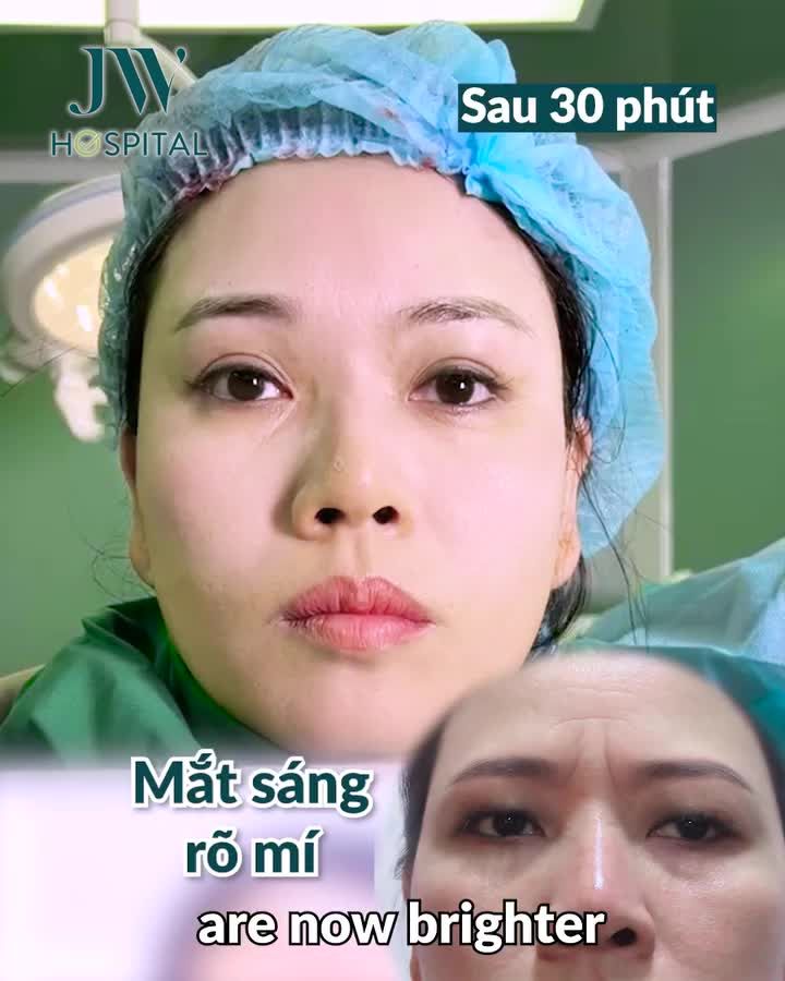 TÁI SINH ĐÔI MẮT TRẺ 10 TUỔI, SẸO TÀNG HÌNH CHO NỮ VIỆT KIỀU NHỜ TREO CHÂN MÀY NỘI SOI 4X