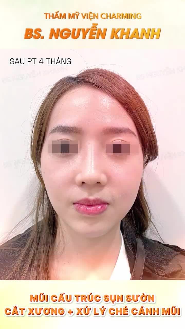 Trước khi đến Charming, nàng khách có sống mũi thấp, đầu mũi tròn và hai bên cánh mũi bị chẻ nhẹ, khiến tổng thể khuôn mặt kém thanh thoát hơn.