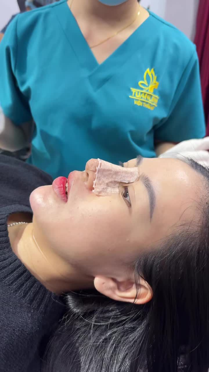Case mũi bọc sụn được 10 ngày - Giá trọn gói chỉ  17TR - 10 ngày đẹp xuất sắc!!